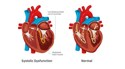 moderate lv systolic dysfunction treatment|systolic left sided heart failure.